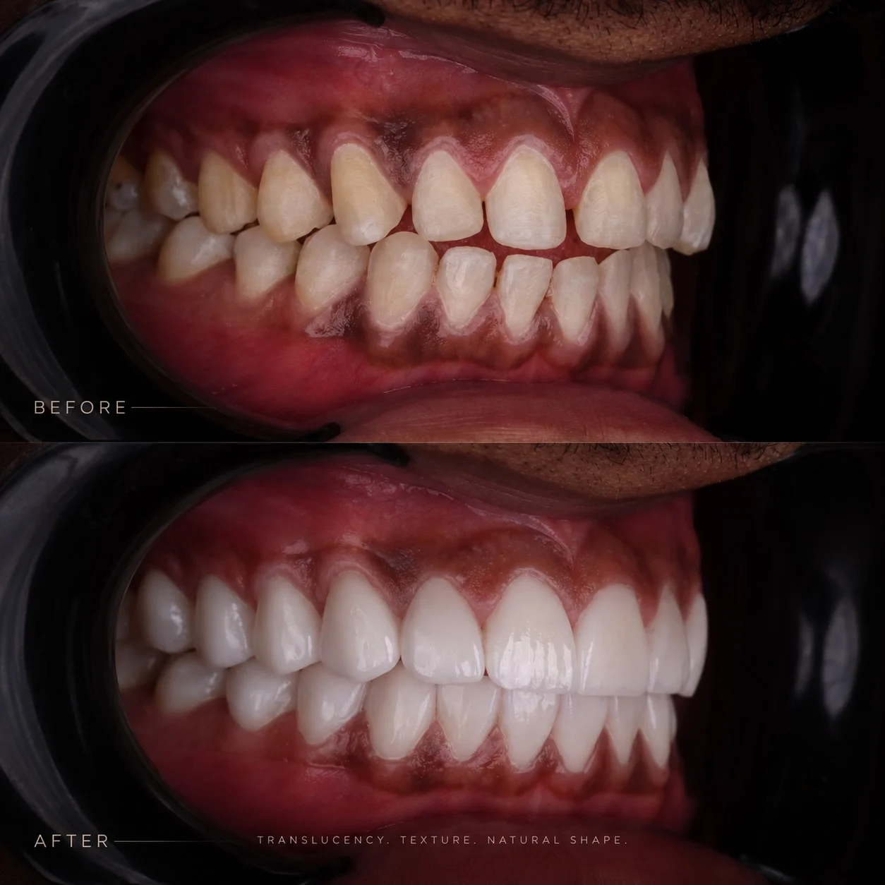 African American patient before/after porcelain veneers